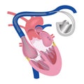 Pacemaker. Heart in longitudinal section.